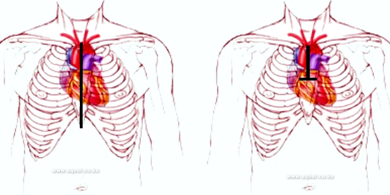 Understanding Sternotomy in Cardiac Surgery