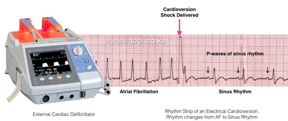 Cardioversion: Restoring Heart Rhythm for Optimal Cardiovascular Health